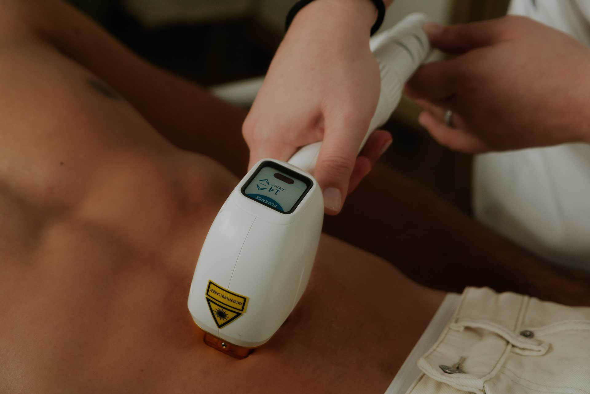 épilation au laser de la ligne de poil ventrale homme